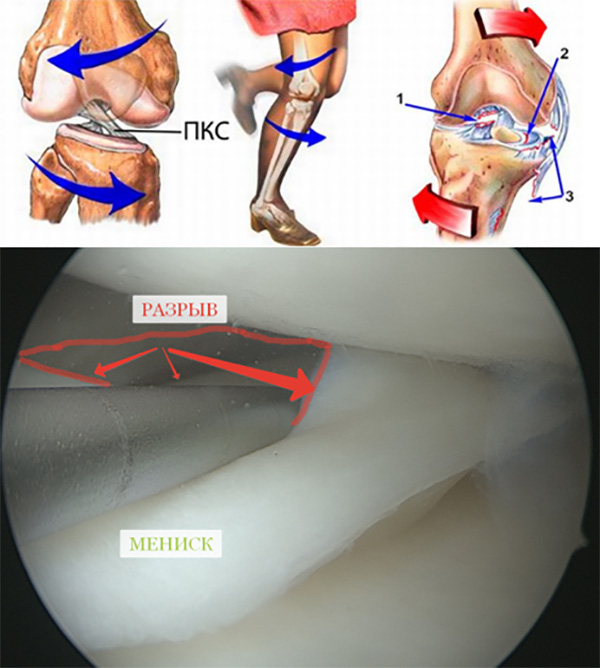 Повреждение менисков левого коленного сустава. Капсулярный разрыв мениска. Разрыв медиального мениска коленного. Мениск 3 степени коленного. Разрыв мениска коленного сустава.